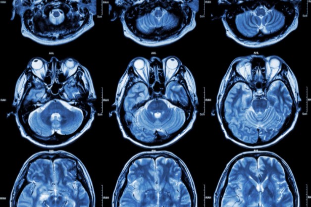 Common Causes Of Brain Injuries