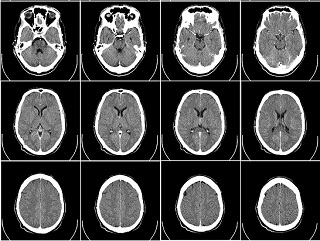 Wrong Side, Wrong Site Brain Surgery Attorney Of Little Rock, Arkansas